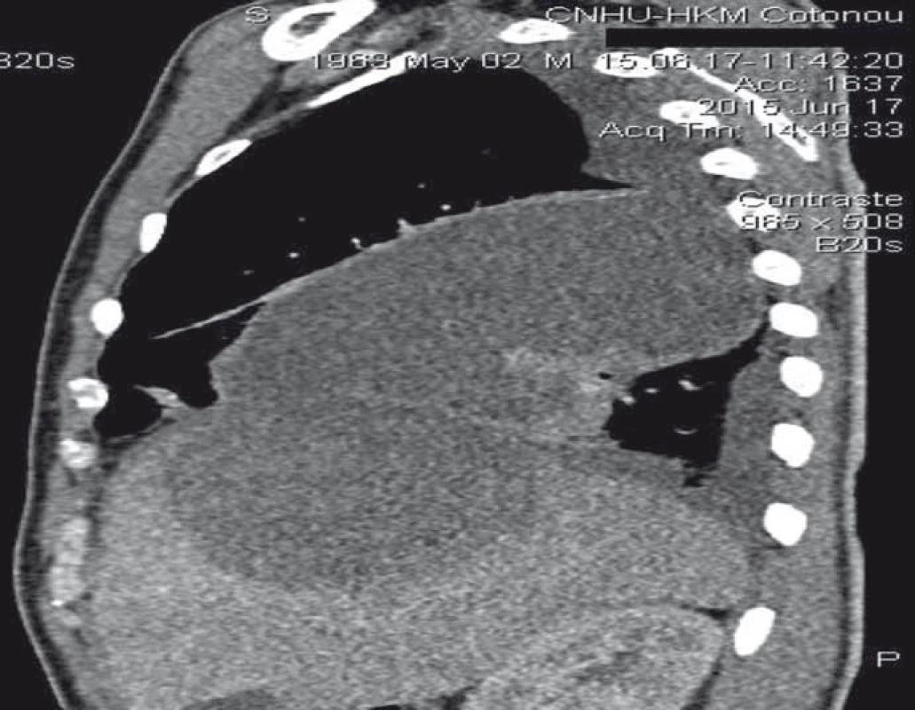 Thoracoabdominal CT scan with sagittal reconstruction showing contiguity between hepatic abscess and pulmonary abscess.<br>
Obr 3. CT hrudníku a břicha se sagitální rekonstrukcí zobrazující propojení mezi
jaterním a plicním abscesem.