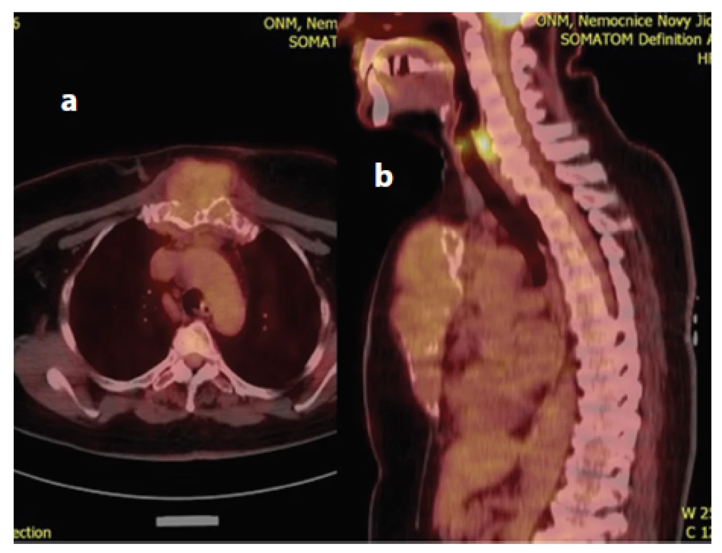 a,b: a) PET/CT obraz prokazující vyšší akumulaci 2-deoxy-2-[18F]fluoro-D-glukózy (18F-FDG) s hodnotami SUV 3,59 v oblasti sterna; b) Metastáza renálního karcinomu sterna v sagitálním PET/CT zobrazení. 
Fig. 2 a,b: a) PET/CT scan showing accumulation of 18F-FDG in the sternum with SUV 3.59; b) Sagittal plane PET/CT scan showing sternal metastasis from renal carcinoma.