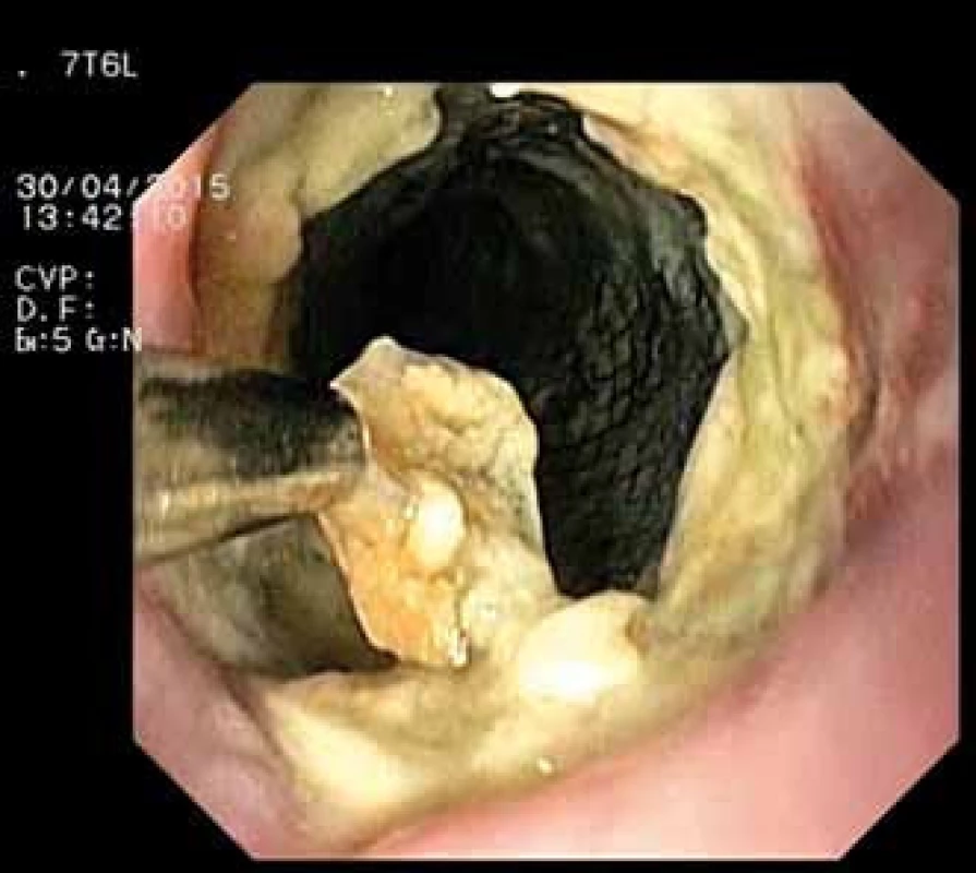 Extrakce Danišova stentu – endoskopický obraz).
Fig. 2. Extraction of Danis stent – endoscopic image.