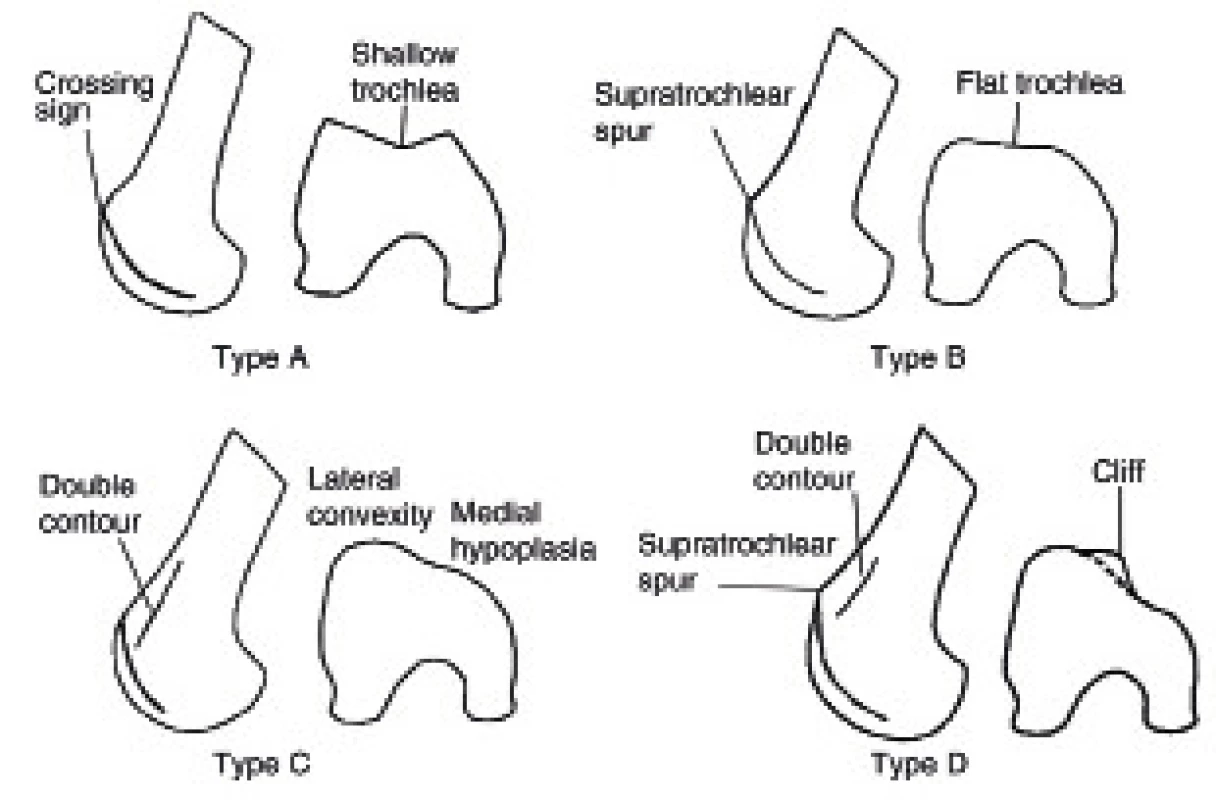 Klasifikace dysplazie trochley podle Dejoura.
<i>(Převzato z Dejour D, LeCoultre B. Osteotomies in patello-femoral instabilities. Sports Med Arthrosc 2007; 15: 39–46.)</i>
Fig. 2. Dejour classification of trochlear dysplasia.
<i>(From Dejour D, LeCoultre B. Osteotomies in patello-femoral instabilities. Sports Med Arthrosc 2007; 15: 39–46.)</i>
