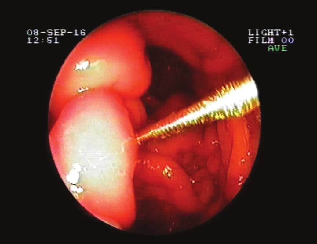 Přerůstající fibrotická tkáň a zanořená fixační ploška
Fig. 2. Outgrowing fibrotic tissue and buried retention plate