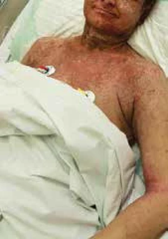 Eczema herpeticatum