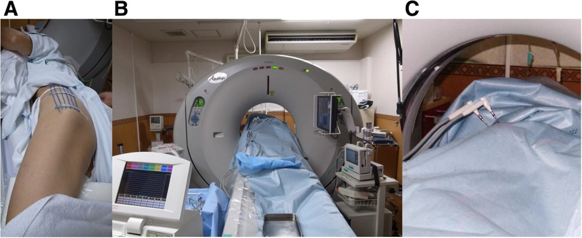 a, b Markers were placed on the left buttock to discern the optimal direction of probe insertion and cryoablation was performed under CT guidance. c Two probes were inserted into the lesion, and an ice ball was monitored to secure at least a 1-cm margin around the tumor