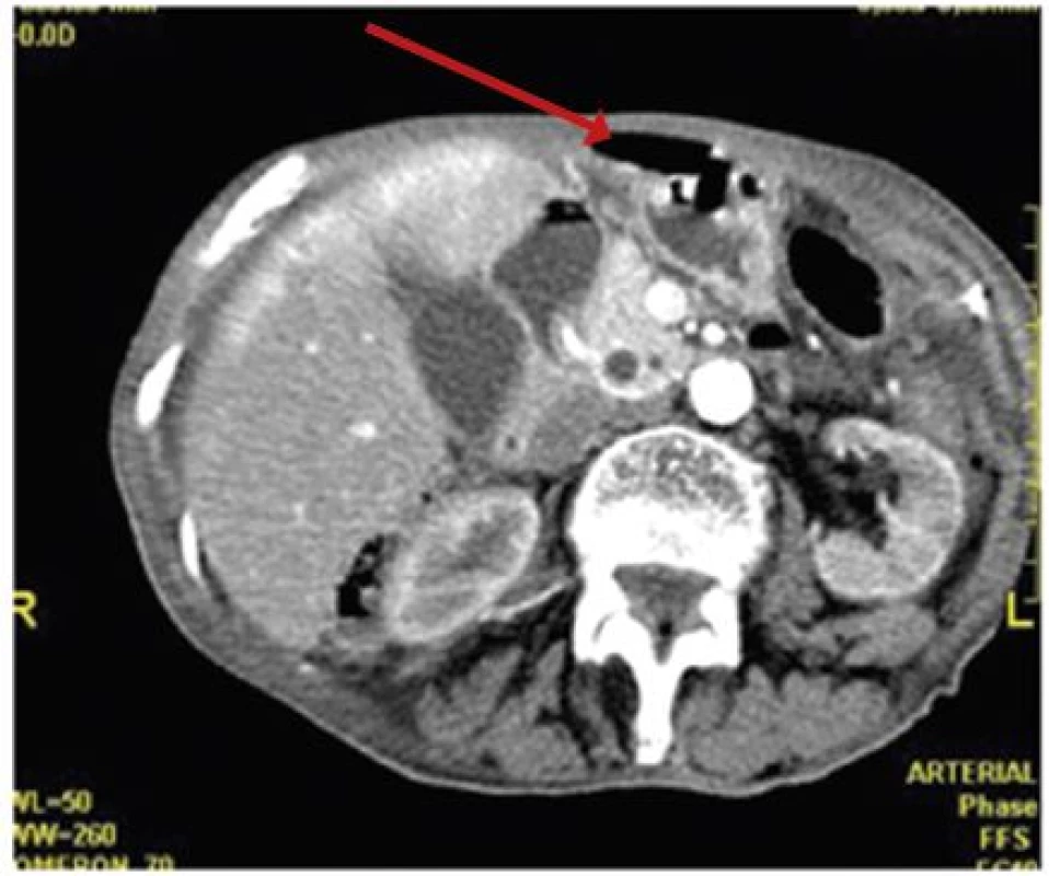 CT nález
Šípka − pneumoperitoneum pri perforácii divertikla – vlastný materiál
Fig. 1: CT finding
The arrow shows pneumoperitoneum in perforated diverticulitis – our own material