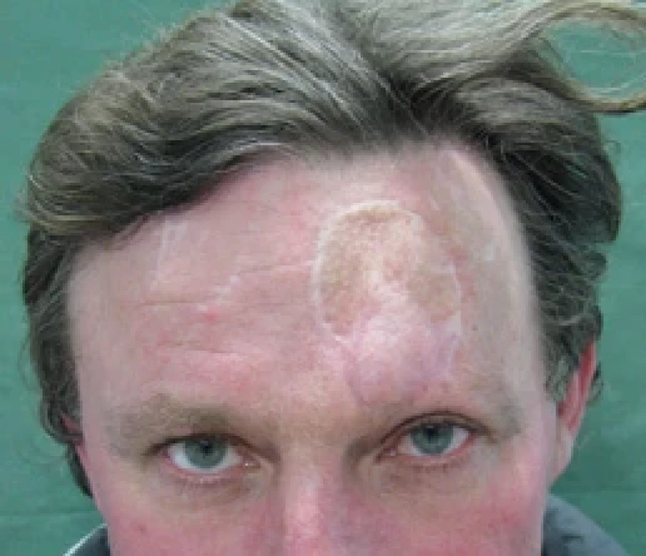 Six months after trauma. Source: archive of authors.