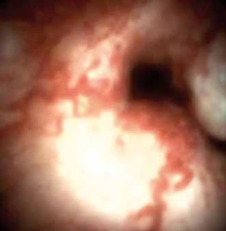 Spirálovité cévy. Cholangiokarcinom.
Fig. 6. Spiral vessels. Cholangiocarcinoma.