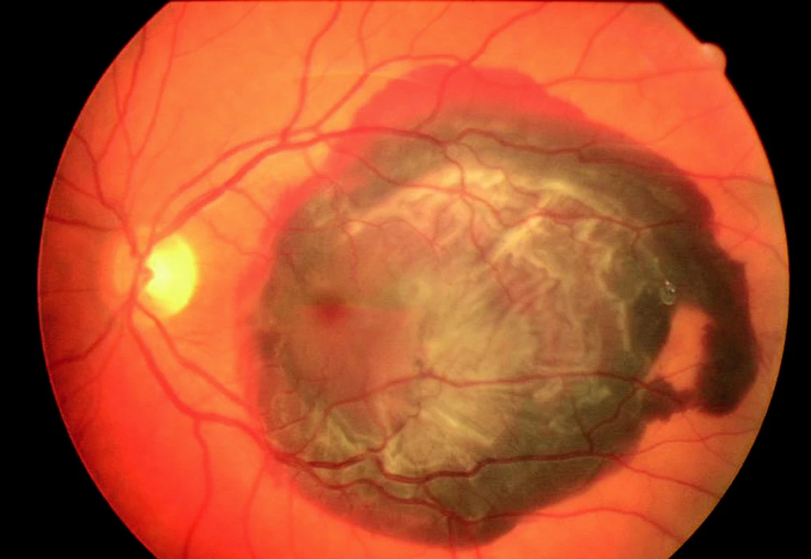 Fundus OL – masivní subretinální hemoragie