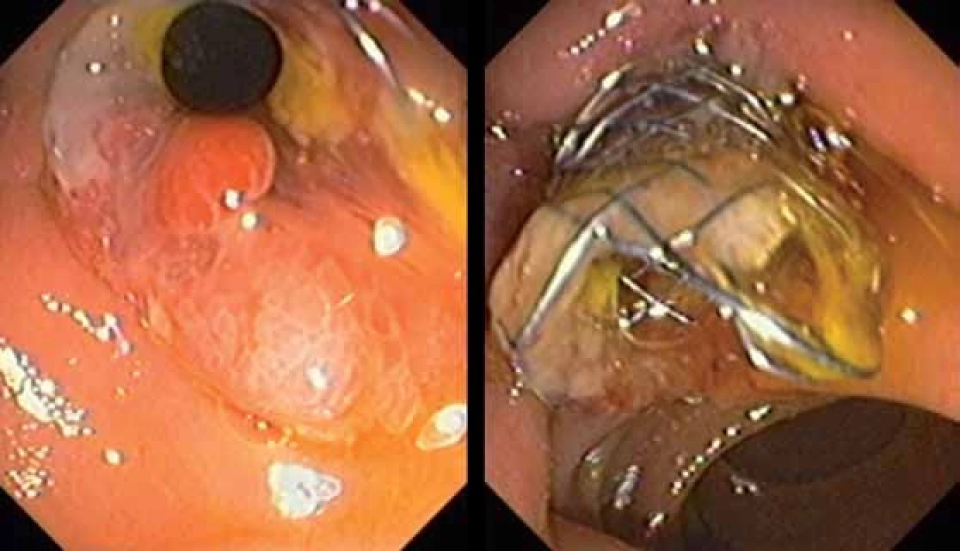 Vľavo biliárny kovový stent 2 mesiace po jeho zavedení. Vpravo cholangiogram bezprostredne po extrakcii kovového stentu, únik žlče nie je prítomný, hepatocholedochus je v oblasti po zavedenom kovovom stentne zjavne dilatovaný.
Fig. 8. On the left side is visible biliary metallic stent 2 months after its insertion. On the right side cholangiogram just after extraction of metallic stent, bile leak is not visible, common bile duct is obviosly dilated in the part where metallic stent was inserted.