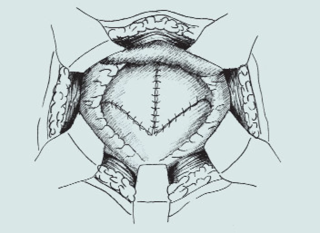Clam-cystoplastika - ileální augmentace.
(A – příprava a rozpolcení m.m., B – izolace distálního segmentu ilea, C – uzavření mezenteria a anastomóza střevní end-to-end, D – detubularizace ileálního segmentu a vytvoření ileální záplaty, E - anastomóza záplaty s měchýřem a uzavření plastiky m.m.)
