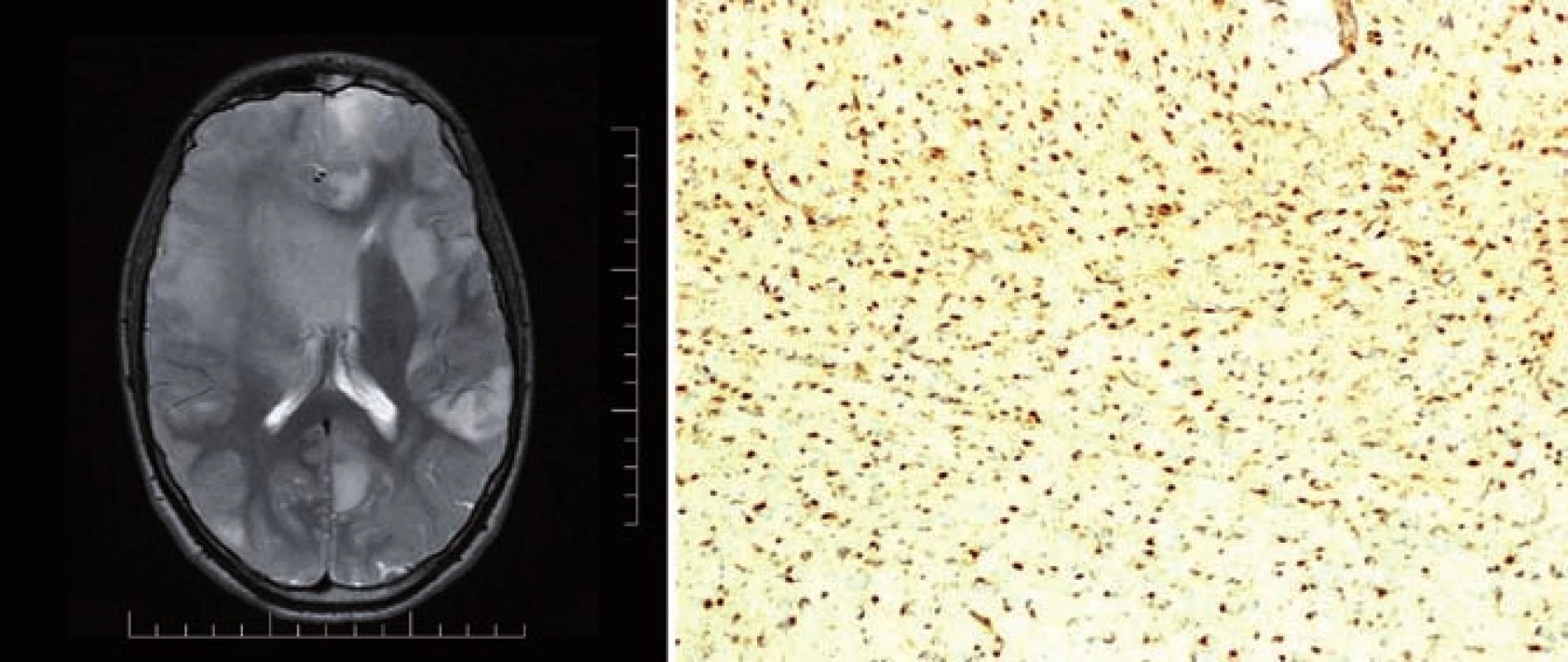 T2 vážený MR obraz pacienta s Ollierovou chorobou, nalezeny vícečetné difuzní astrocytomy mozku (A) a imunohistochemický průkaz mutace <i>IDH1</i> R132H, 100% pozitivita (B).
Fig. 1. T2-weighted MR image of a patient with the Ollier disease, multiple diffuse astrocytomas of the brain found (A) and immunohistochemical evidence of the <i>IDH1</i> R132H mutation, 100% positivity (B).