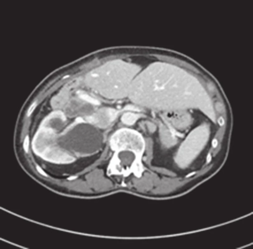 CT obraz infiltrace lymfatických uzlin hepatoduodenálního ligamenta goblet-cell karcinoidem (venózní fáze, axiální řez)
Fig. 2: CT scan infiltration of hepatoduodenal lymph nodes with goblet-cell carcinoma (venous phase, axial view)