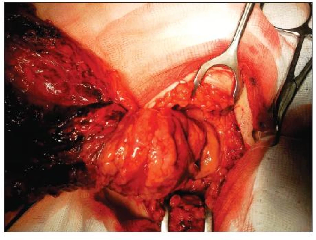 Torze omenta – detail
Fig. 2. Torsion of the omentum – a detail view