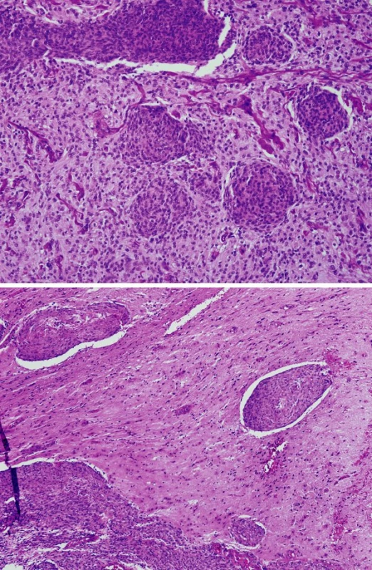 Difúzne rastúci meningeóm. Ložiskovo zachovaný rast v lalôčikoch s vírovitým usporiadaním (a). Invázia do parenchýmu mozgu (b). HE, zväčšenie 100 a 40-krát