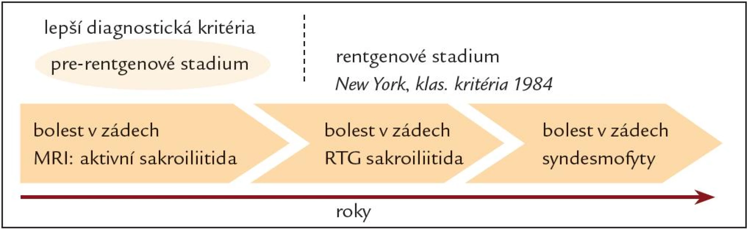 Ankylozující spondylitida.