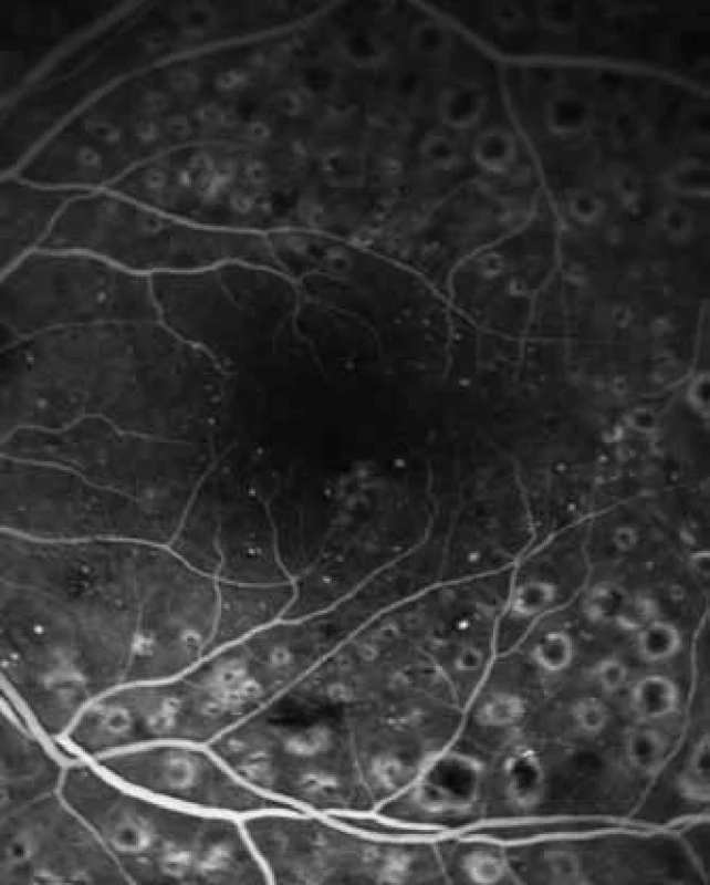 FAG – ústup prosakování po fokální laserkoagulaci v místě prosakování kontrastní látky.