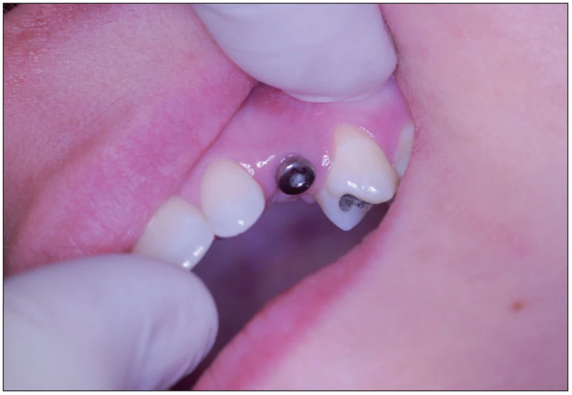 Vhojovací váleček u implantátu v pozici 23 in situ.