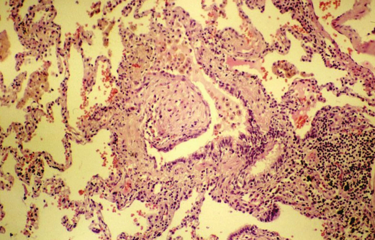 Bronchiolitis obliterans s polypoidním útvarem uvnitř lumina, jak byl zaznamenán u organizující se pneumonie. HE,240krát