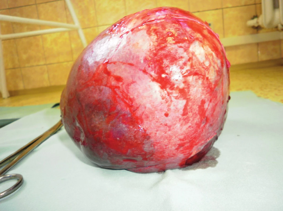 Poúrazová pseudocysta sleziny – preparát
Fig. 5. Post-traumatic pseudocyst of the spleen – preparation