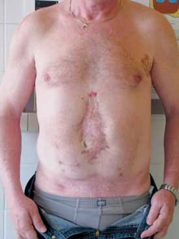 Pacient po břišní operaci pro akutní pankreatitidu
Fig 3. Patient after abdominal surgery dute to acute pancreatitis