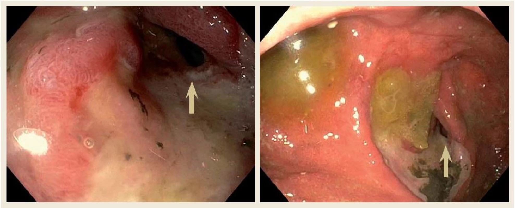 Horní endoskopický nález ukázal kompletní vymizení tumorózní infiltrace v oblasti duodena po třech měsících chemoterapie. V místě původní tumorózní léze byla nalezena vředová léze s mírnou stenózou duodena prostupnou pro endoskop (šipka).
Fig. 4. Upper gastrointestinal endoscopy of our patient after three months of chemotherapy showing no mass in the duodenum. In place of the mass, endoscope revealed chronic peptic ulceration with mild stenosis (arrow).
