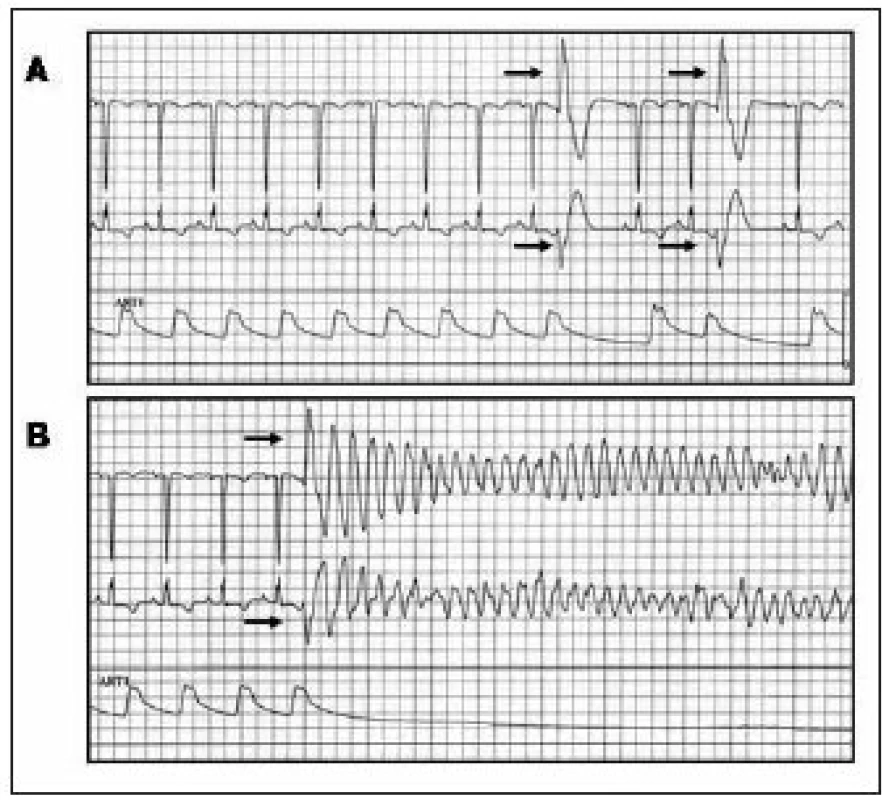 Komorová extrasystola iniciující fibrilaci komor u pacientky se srdeční amyloidózou.
EKG-záznam a křivka invazivně měřeného krevního tlaku: (A) během izolovaných komorových extrasystol vycházejících z levé komory, (B) během extrasystoly identické morfologie (šipky), která spustila FK.