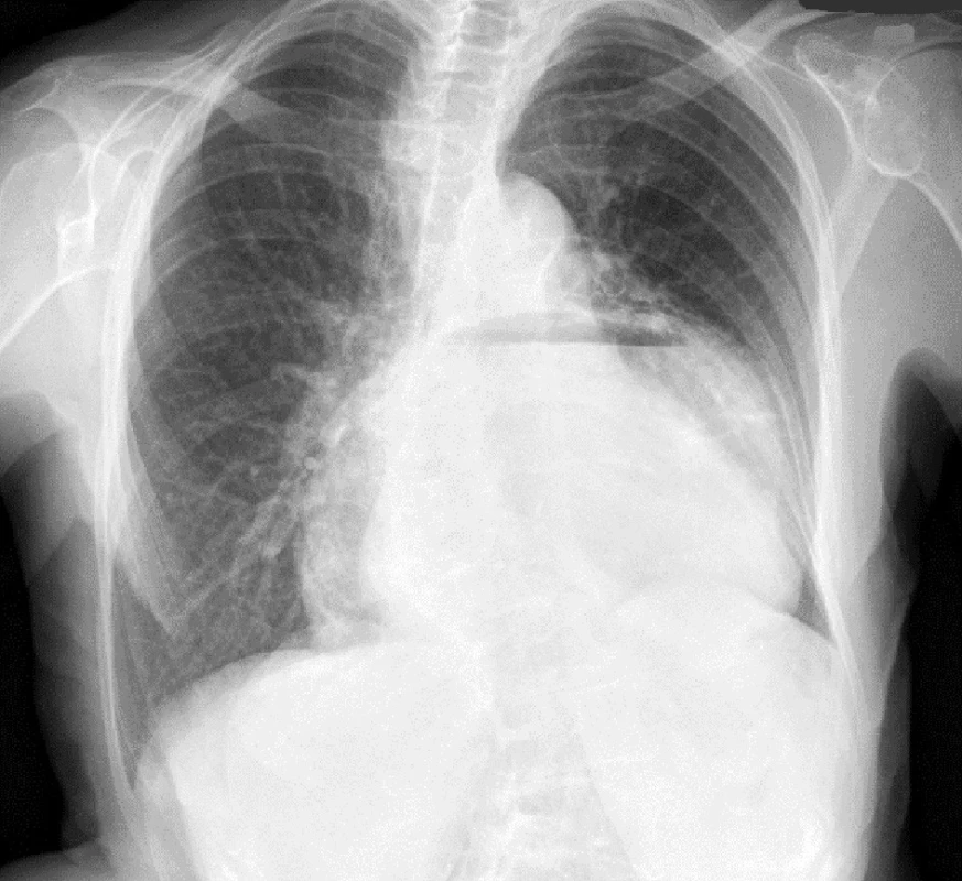 Rtg snímek hrudníku
Fig. 7: X-ray image of the chest