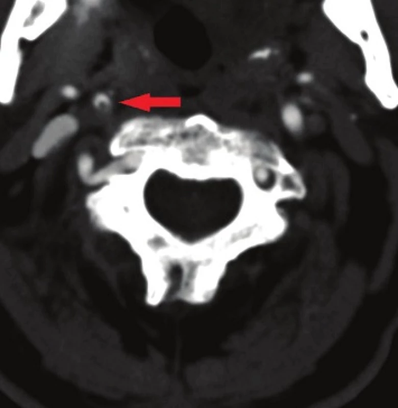 Volně vlající trombus ve vnitřní karotidě
Fig. 3: Free-floating thrombus in the internal carotid artery