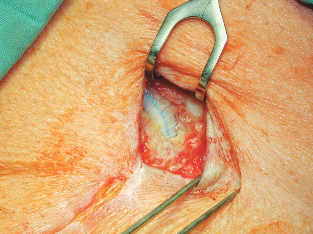 Stav po nekrektomii před přiložením V.A.C.
Fig. 3. A wound after necrectomy before V.A.C. application