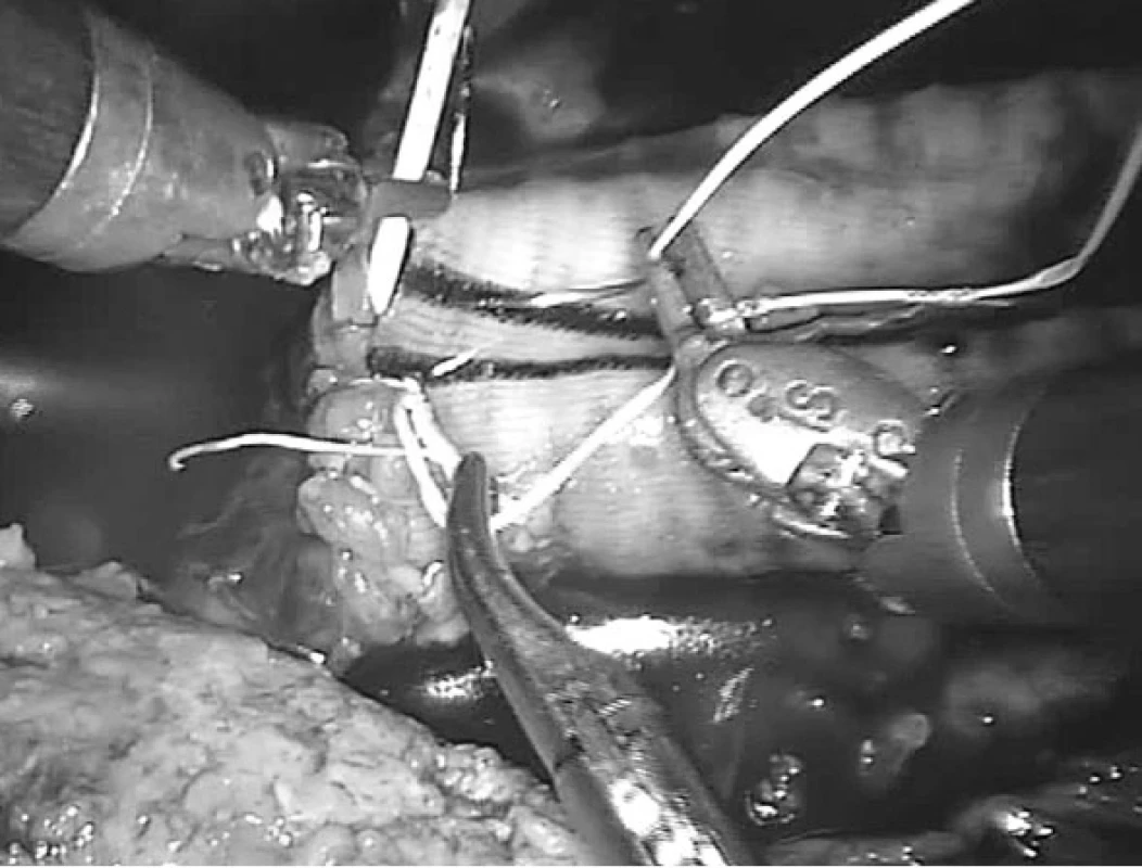 Robotická periferní anastomoza „end-to-end“ (výduť břišní aorty, aorto-aortální náhrada)