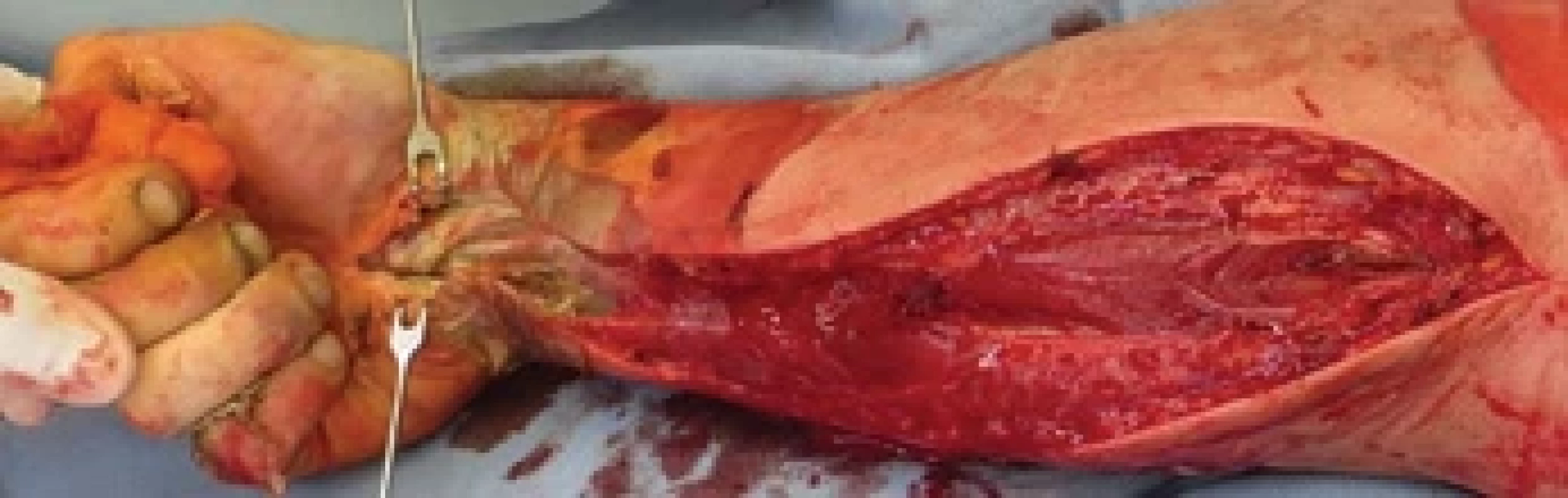 Right upper limb after necrectomy and fasciotomy.