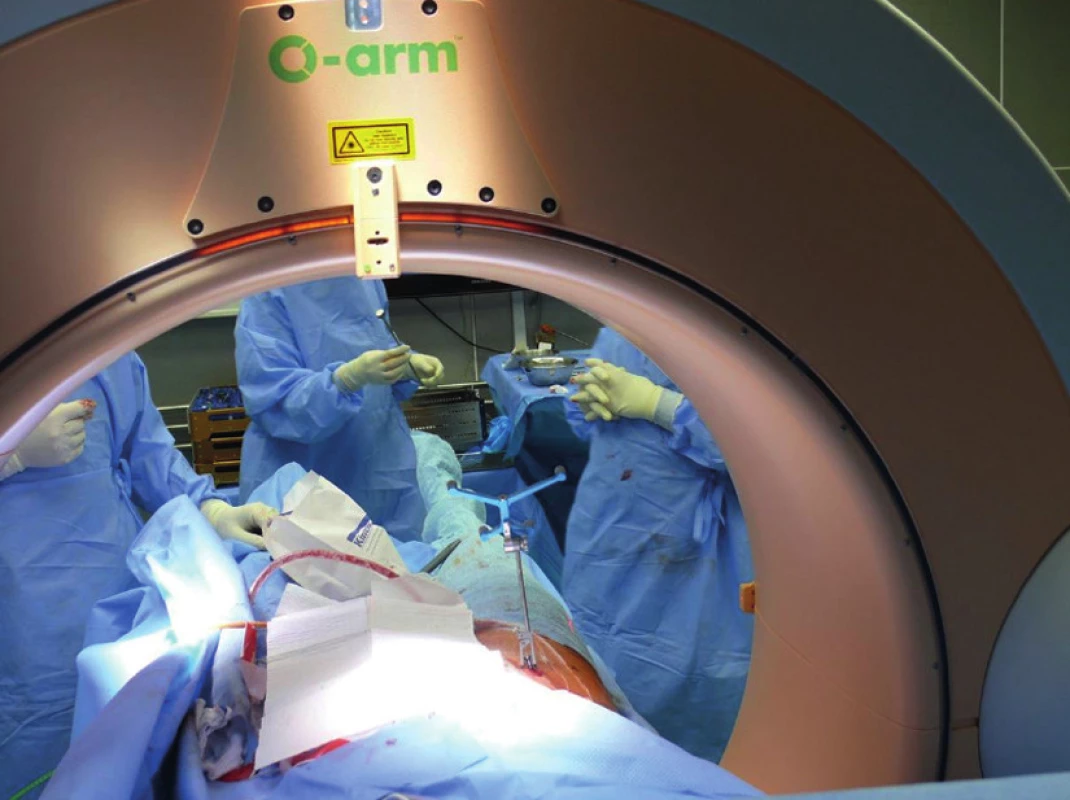 Navigace pomocí intraoperativního CT (O-rameno)
Fig. 2: Intraoperative navigation with CT (O-arm)