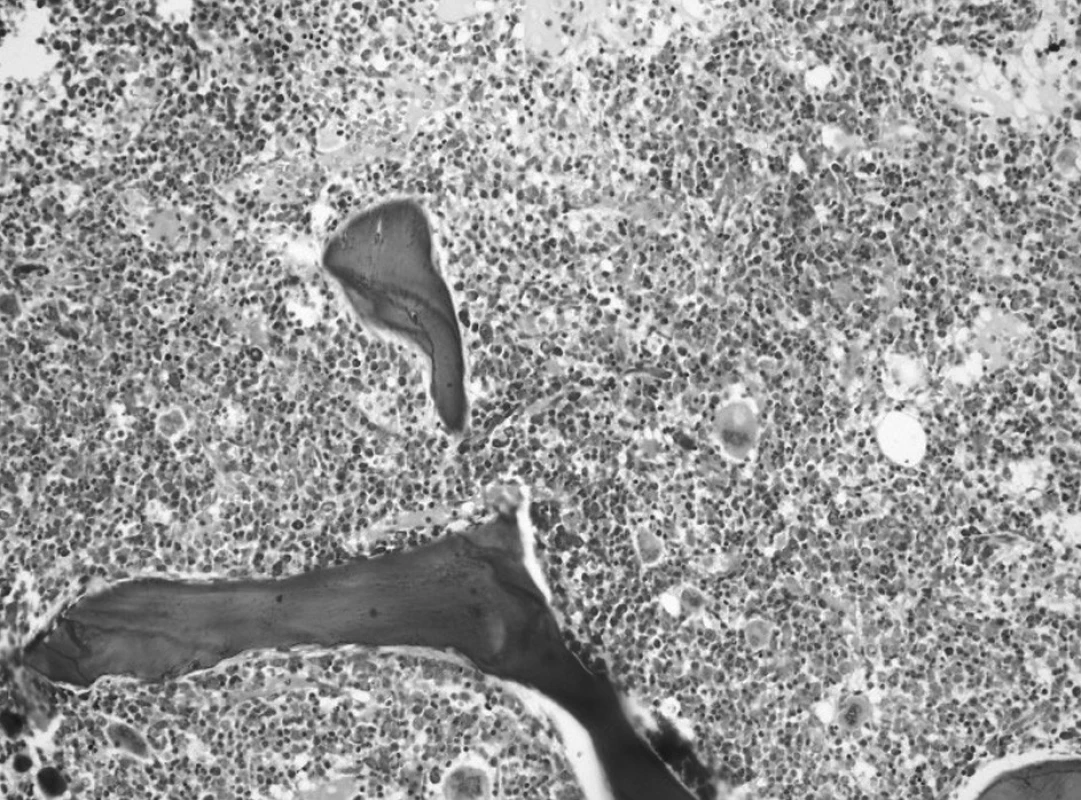 Druhé trepanobioptické vyšetrenie: hypercelulárna dreň s črtami myeloproliferatívnych a myelodysplastických zmien (Giemsa, 20x).
Fig. 4. Second trepanobioptic examination: hypercellular bone marrow with marks of myeloproliferative and myelodysplastic changes (Giemsa, 20x).