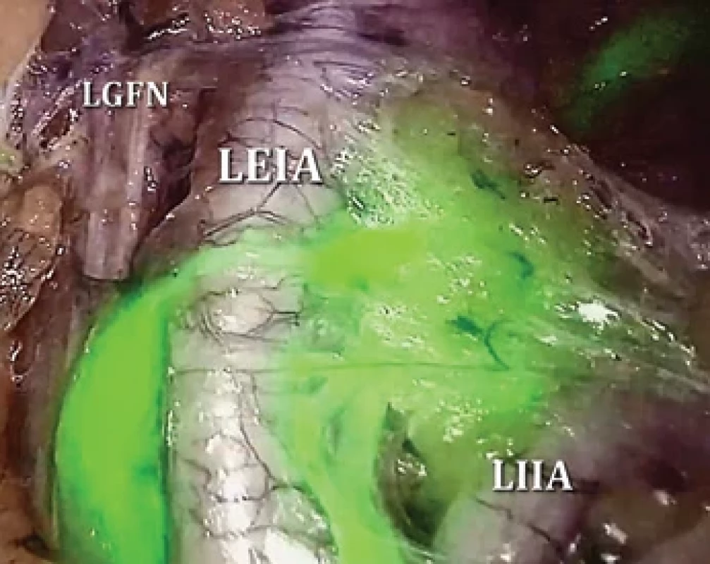 Left external iliac SLN identified by near-infrared fluorescence after ICG injection into the cervix.