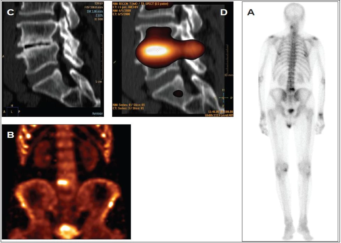 Benigní osteochondróza meziobratlové ploténky mezi 4. a 5. bederním obratlem.