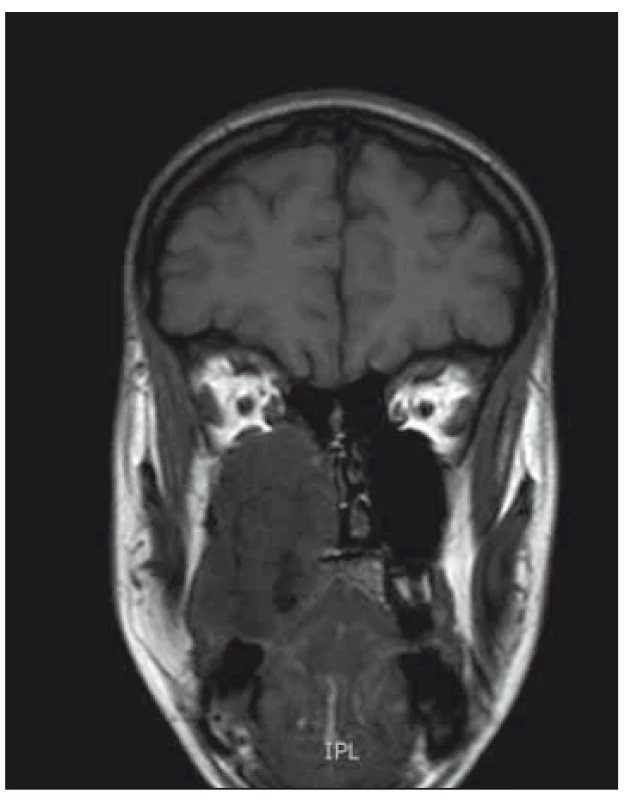 MRI coronar view – demonstrates
large mass in the maxilla extending to the
nasal cavity, also causing bulging and destruction
of hard palate.<br>
Obr. 1. MR koronární pohled – zobrazuje
masivní hmotu v horní čelisti až do nosní
dutiny, což také způsobuje deviaci a destrukci
tvrdého patra.