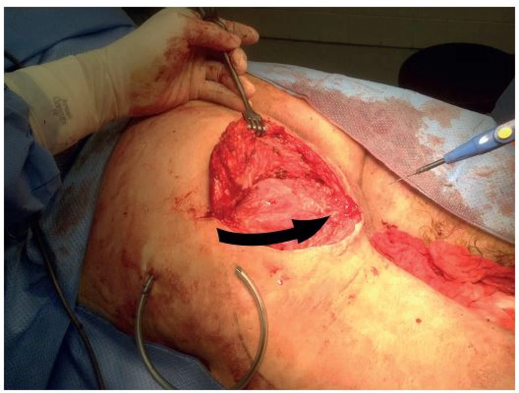 Transpozice gluteálního laloku do defektu
Fig. 5: Transposition of gluteal flap into the defect