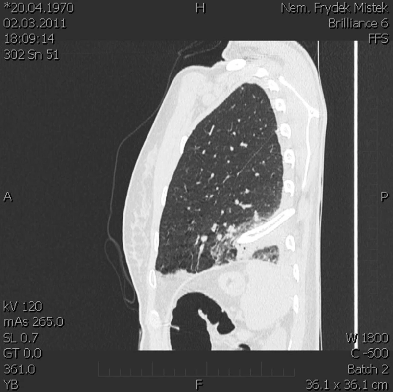 CT rekonstrukce patrná dislokace zlomeného VIII. žebra vlevo s kontuzí plíce bez pneumohemotoraxu
Fig. 3. CT reconstruction- dislocation of the fractured 8th rib on the left side with lung contusion, no pneumohaemothorax is detected