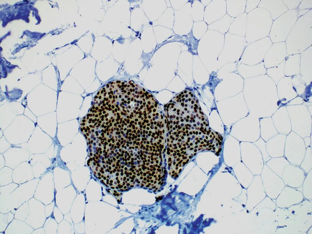 Imunohistochemický průkaz progesteronových receptorů v meningoteliálních buňkách