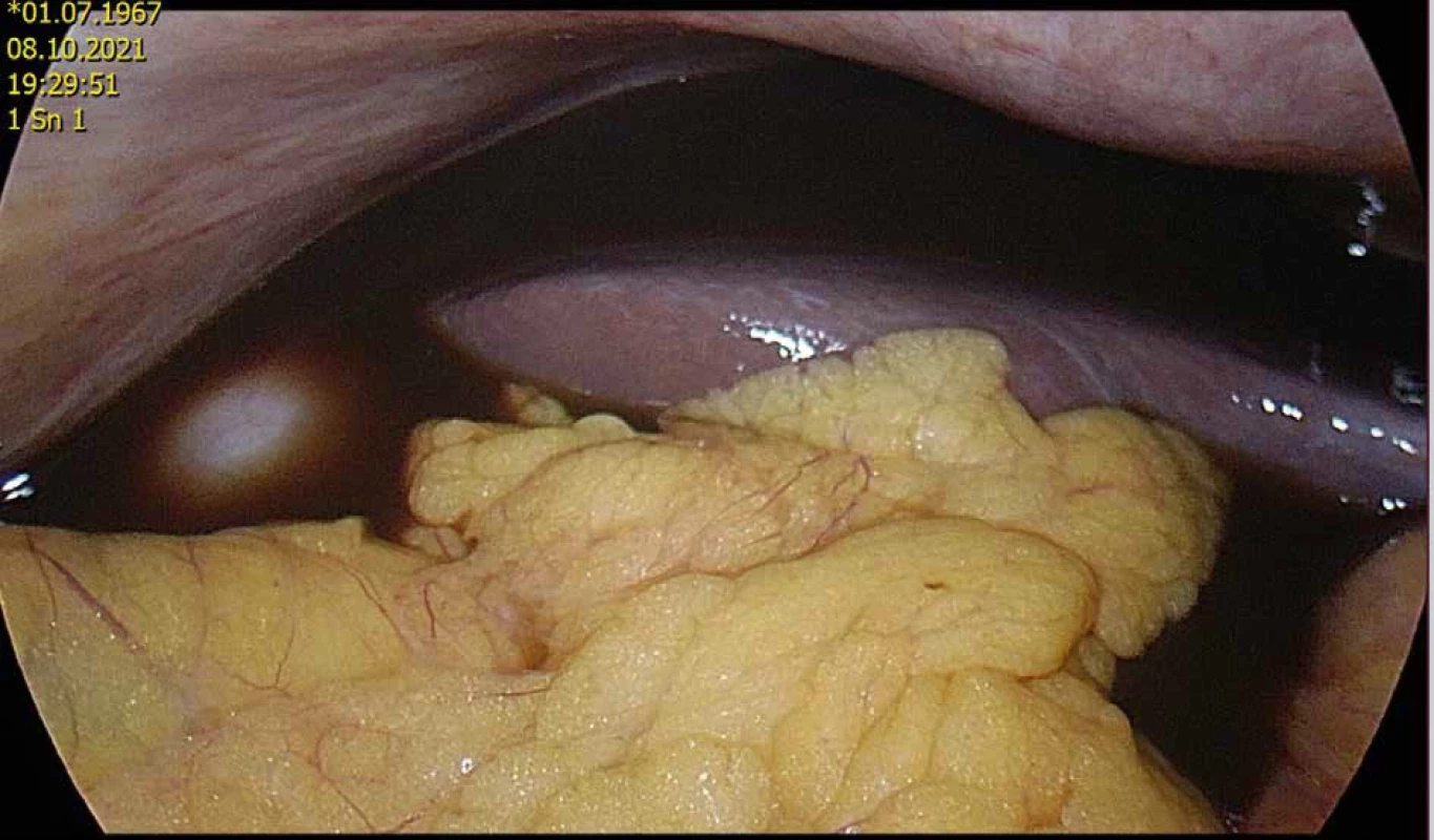 Laparoskopická revize pro perforovaný vřed duodena Fig. 4: Laparoscopic surgery for perforated duodenal ulcer