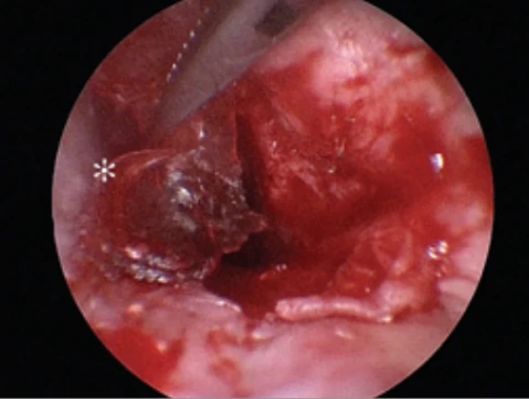 Endoskopický pohled na vkládání perichondrálního štěpu (*) na celou ploténku třmínku. Fig. 4. Endoscopic view of placement of a perichondrial graft (*) over the entire stapes footplate.