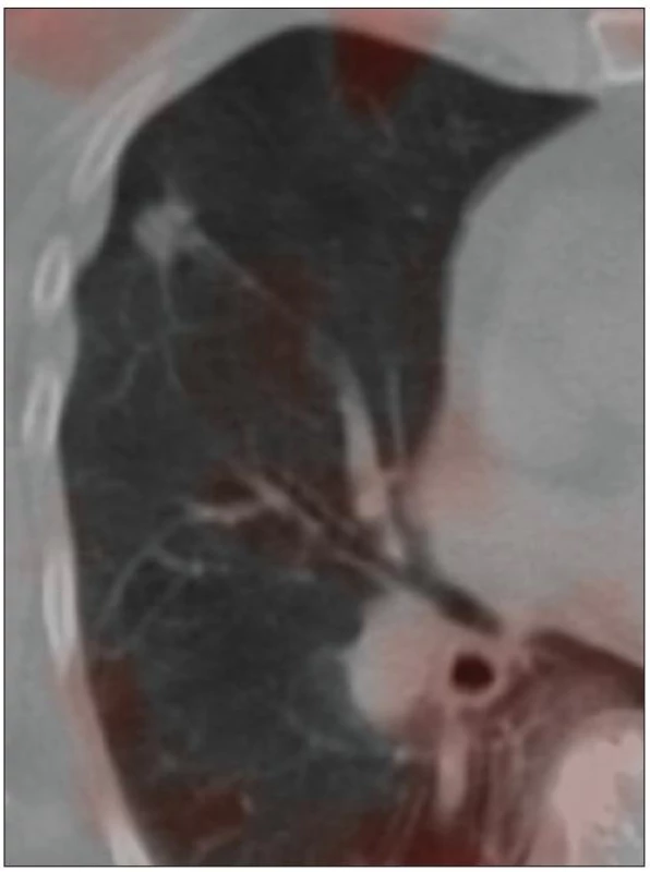 SPECT/CT s aplikací <sup>111</sup> In-DTPA-oktreotidu (04/2010). Ložisko bez známek patologické exprese somatostatinových receptorů.