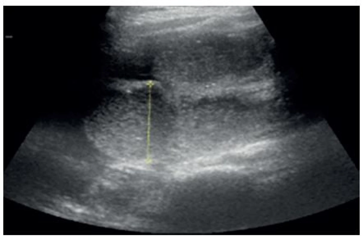 Dilatované kličky ilea
Fig. 1: Distension of the small intestine