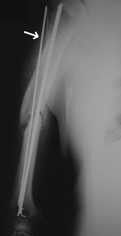 RTG snímek hypertrofického pakloubu diafýzy humeru při nitrodřeňové osteosyntéze podle Hackethala. Kirschnerův drát zavedený mimo dřeňovou dutinu označen šipkou
Fig. 1. X-ray picture of hypertrophic nonunion of the humeral shaft with intramedullar osteosynthesis sec Hackethal. K-wire positioned extramedullary is marked with arrow