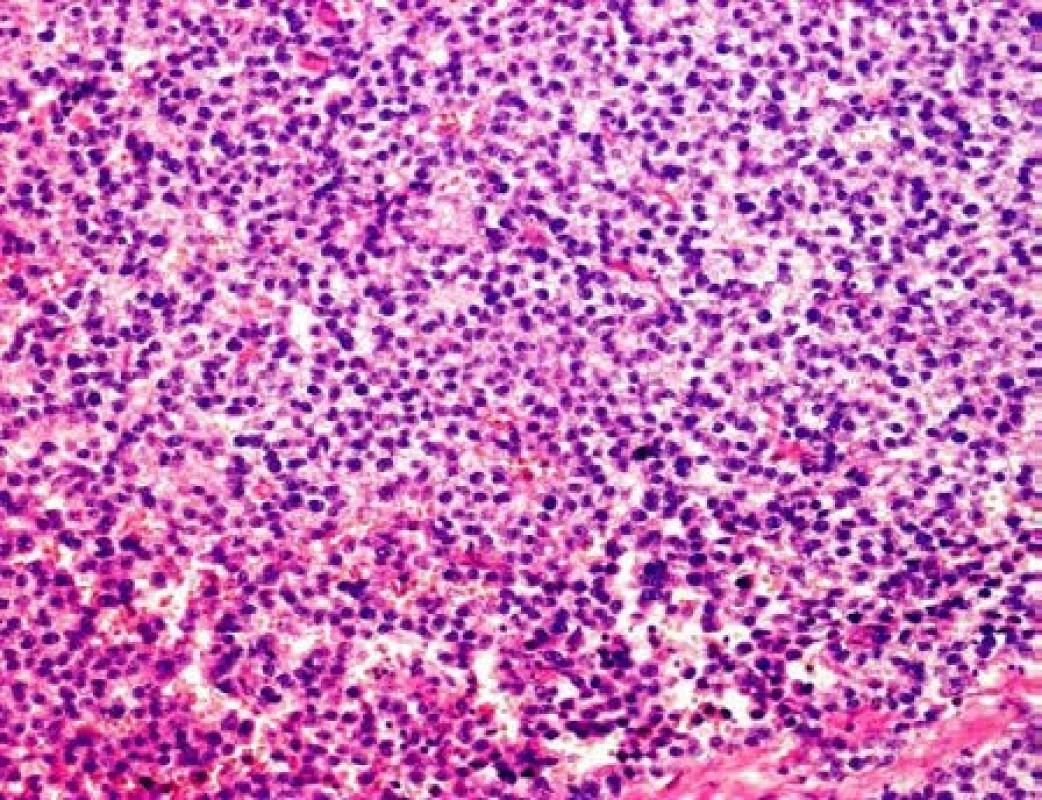 Mikroskopický preparát – klasický seminom, barvení HE, zvětšení 200x
Fig. 6. Histopathological image of seminoma, HE stain, at 200x