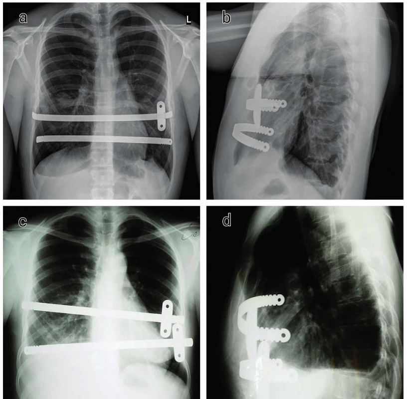 RTG nález u pacientov po MIRPE
a−b) 17ročný pacient
c−d) 27ročná pacientka
Fig. 4. CXR in patients after MIRPE
a−b) 17-year-old male
c−d) 27-year-old female