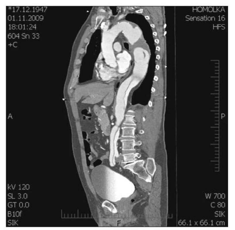 TAAA II. typ podle Crawforda na podkladě chronické disekce (CT-AG)
Fig. 8. TAAA, type II according to Crawford, in the presence of chronic dissection (CT-AG)