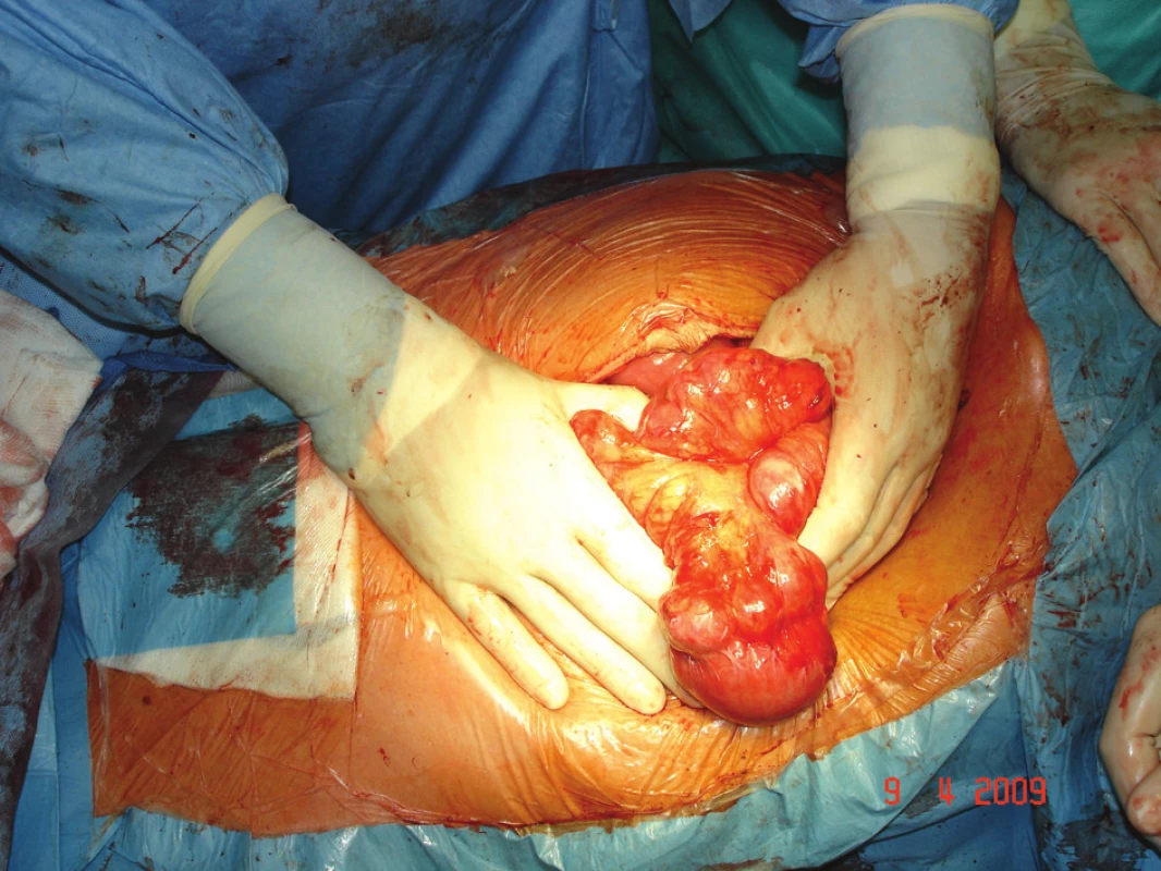 Divertikulóza jejuna
Fig. 2. Jejunal diverticulosis