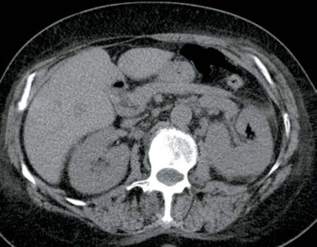 Ve srovnání s obrázkem 7 je následující den vidět ložisko plynu uvnitř parenchymu levé ledviny
Fig. 8. Gas deposit in left kidney parenchyma – next day in comparison with fig. 7