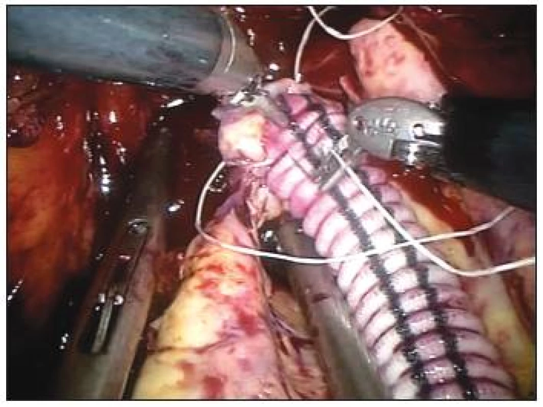 Výduť pánevní tepny, periferní anastomóza
Fig. 3. Aneurysm of the pelvic aorta, peripheral anastomosis