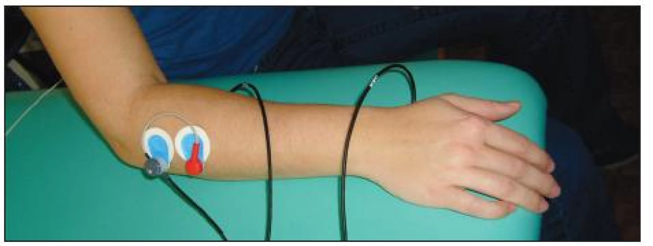 Umístění elektrod: m. extensor carpi radialis.